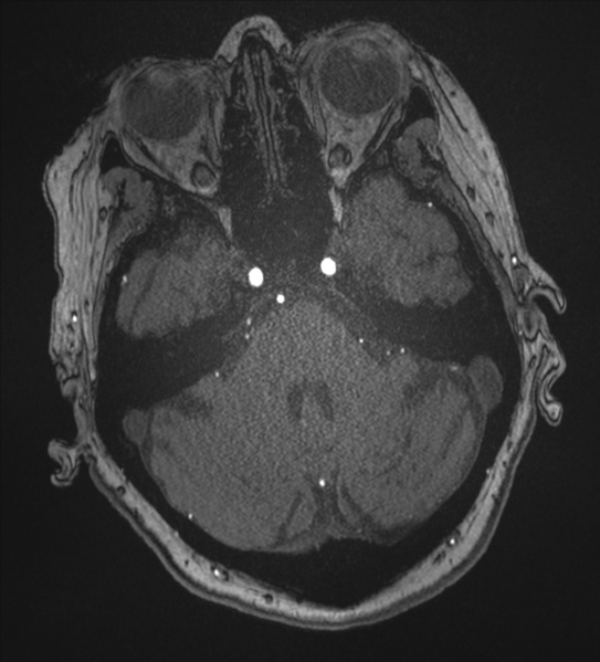 File:Bilateral fetal posterior communicating arteries (Radiopaedia 41286-44102 Axial MRA 48).png