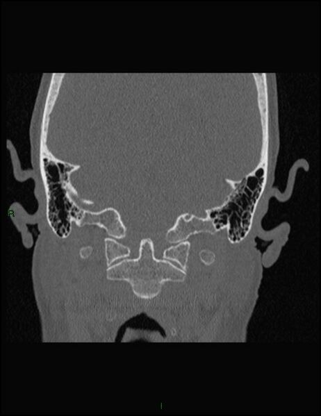 File:Bilateral frontal mucoceles (Radiopaedia 82352-96454 Coronal 346).jpg