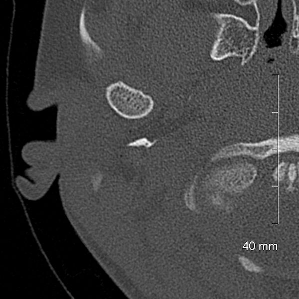 File:Bilateral grommets (Radiopaedia 47710-52404 Axial bone window 3).jpg
