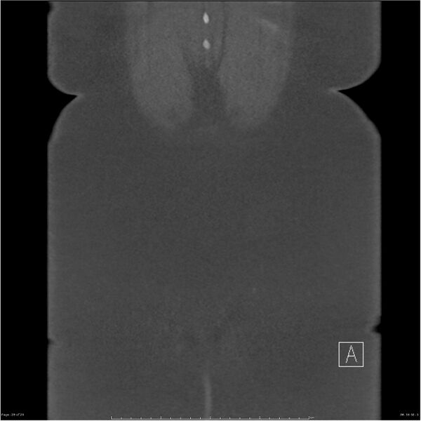 File:Bilateral lumbar ribs (Radiopaedia 25862-26010 Coronal bone window 28).jpg