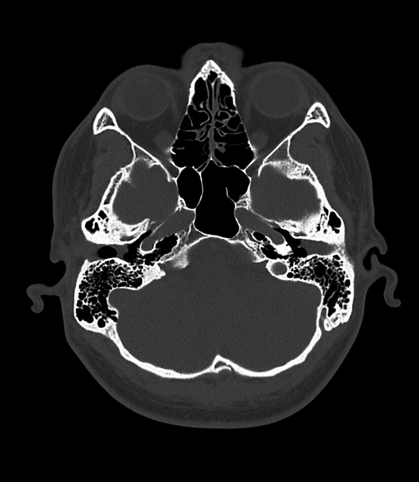 Bilateral medial canal fibrosis (Radiopaedia 85598-101344 Axial bone window 27).jpg