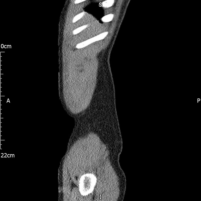 Bilateral medullary nephrocalcinosis with ureteric calculi (Radiopaedia 71269-81569 C 106).jpg