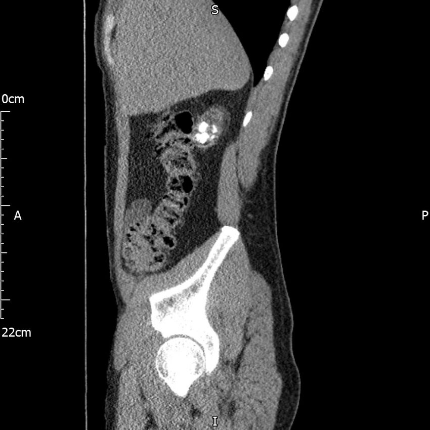 Bilateral medullary nephrocalcinosis with ureteric calculi (Radiopaedia 71269-81569 C 88).jpg