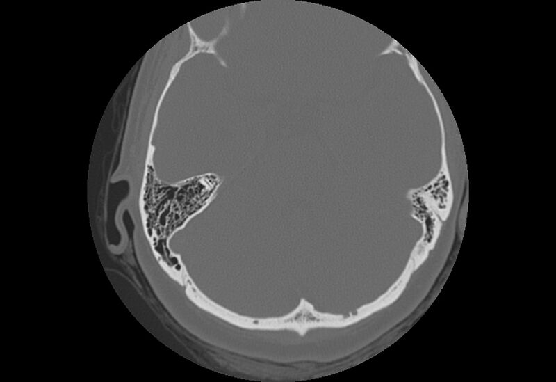 File:Bilateral otospongiosis (Radiopaedia 35447-36940 Axial bone window 48).jpg