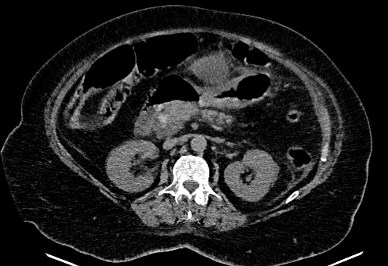 File:Biliary pancreatitis (Radiopaedia 72289-82823 Axial non-contrast 113).jpg
