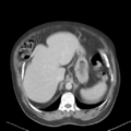 Bladder papillary urothelial carcinoma (Radiopaedia 48119-52951 Axial 8).png
