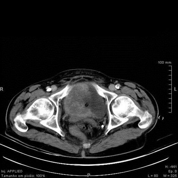 File:Bladder squamous cell carcinoma (Radiopaedia 14130-13984 B 11).jpg