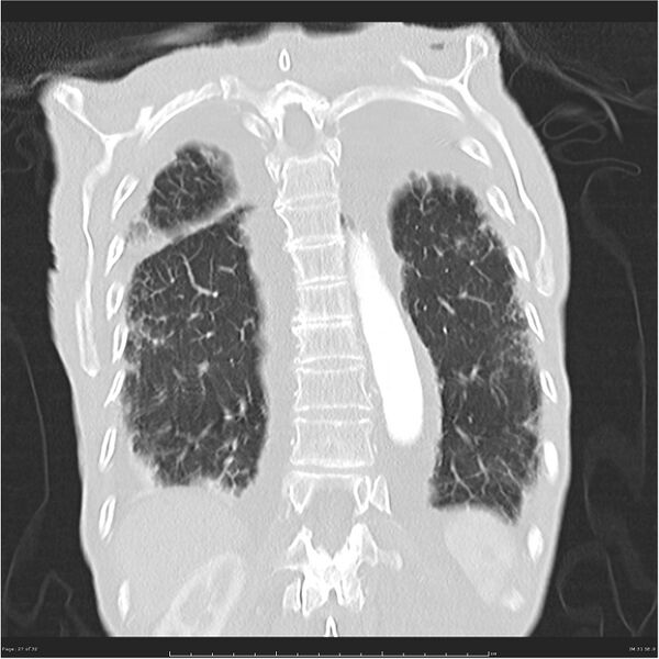 File:Boerhaave syndrome (Radiopaedia 26240-26362 Coronal lung window 27).jpg