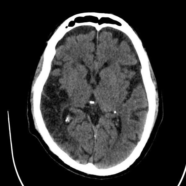 File:Brain Pantopaque remnants (Radiopaedia 78403-91048 Axial non-contrast 50).jpg