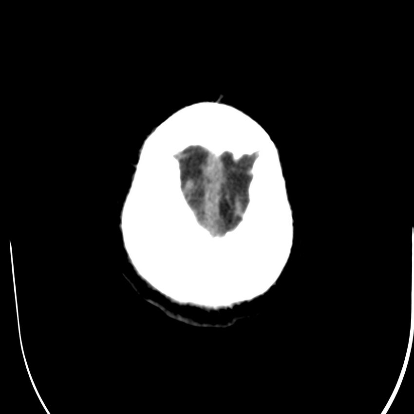 Brain Pantopaque remnants (Radiopaedia 78403-91048 Axial non-contrast 86).jpg
