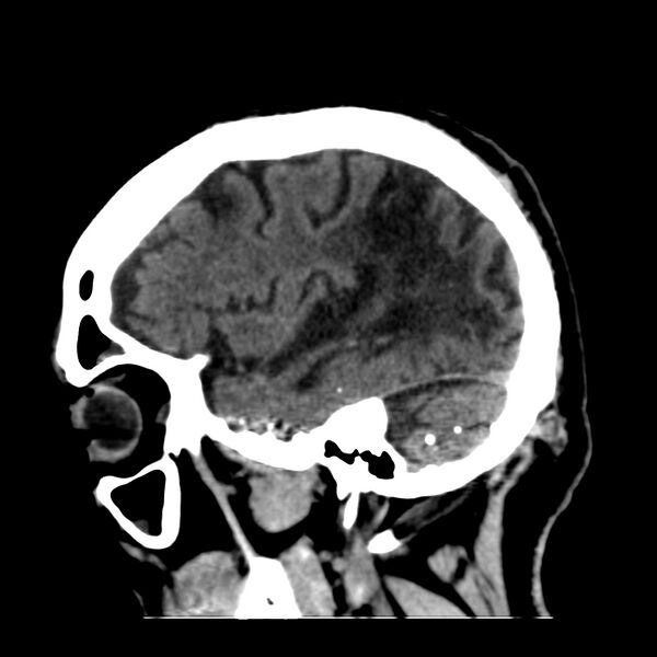 File:Brain Pantopaque remnants (Radiopaedia 78403-91048 C 15).jpg