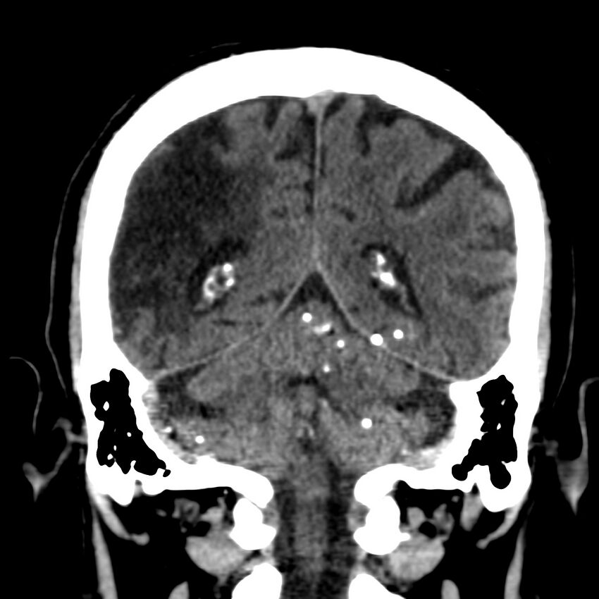 Brain Pantopaque remnants (Radiopaedia 78403-91048 Coronal non-contrast 49).jpg