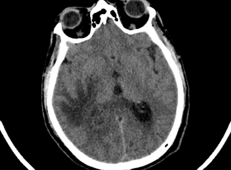 File:Brain abscess complicated by intraventricular rupture and ventriculitis (Radiopaedia 82434-96575 Axial non-contrast 41).jpg