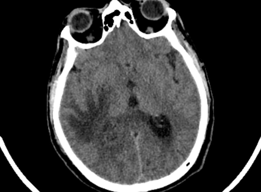 Brain abscess complicated by intraventricular rupture and ventriculitis (Radiopaedia 82434-96575 Axial non-contrast 41).jpg