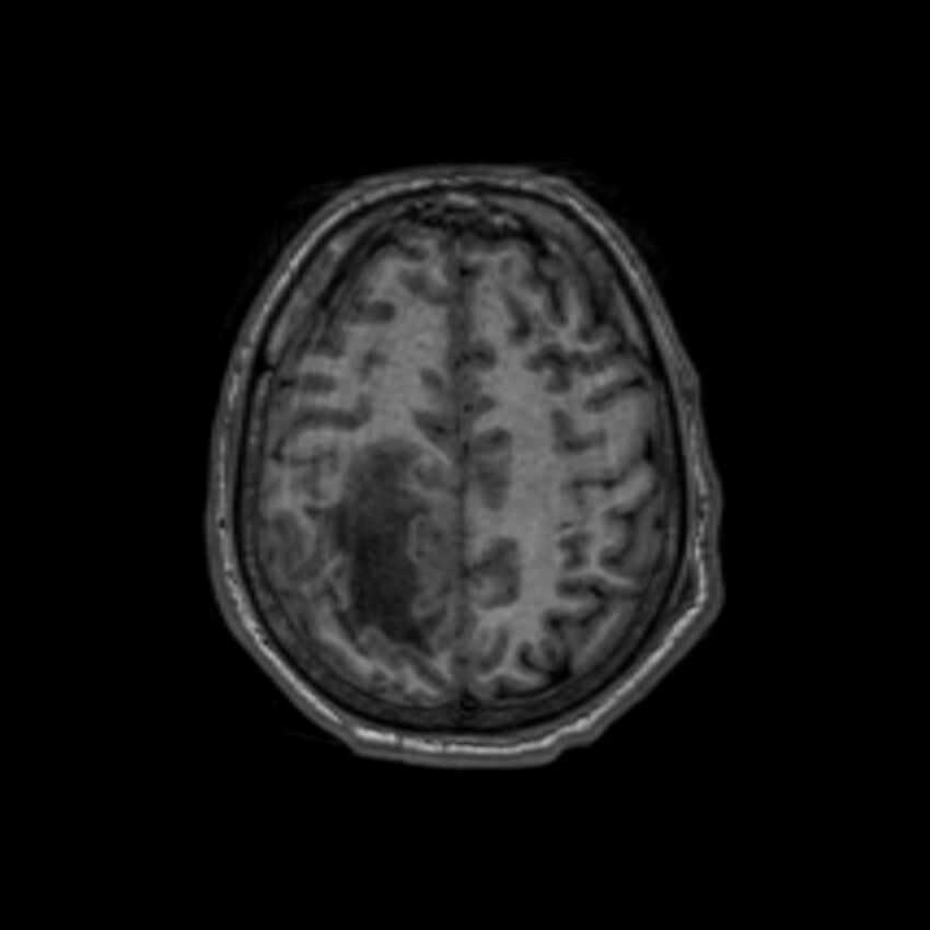 Brain abscess complicated by intraventricular rupture and ventriculitis (Radiopaedia 82434-96577 Axial T1 55).jpg