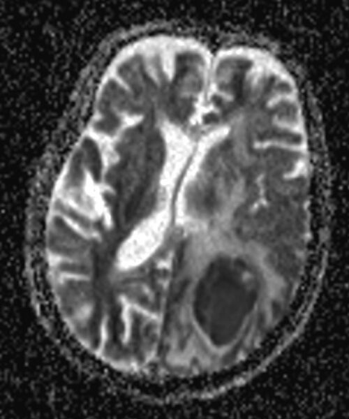 File:Brain abscess with dual rim sign (Radiopaedia 87566-103938 Axial ADC 11).jpg