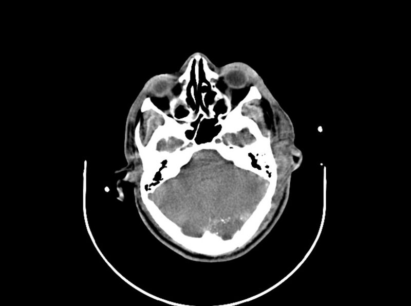 File:Brain injury by firearm projectile (Radiopaedia 82068-96087 B 67).jpg