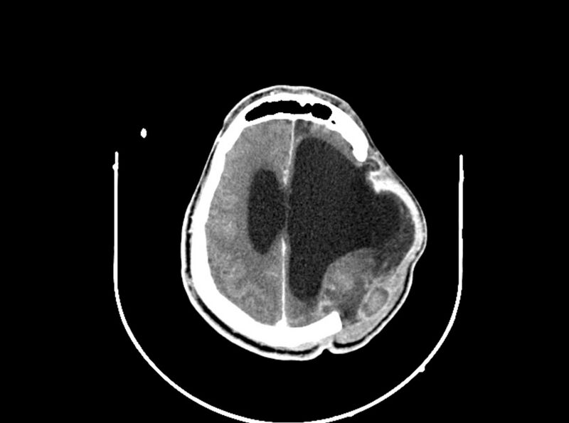 File:Brain injury by firearm projectile (Radiopaedia 82068-96088 B 160).jpg