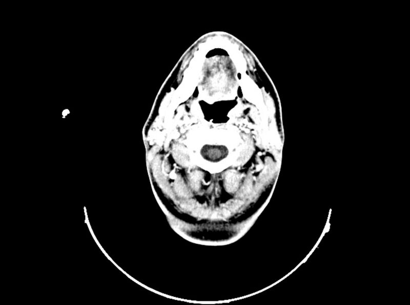 File:Brain injury by firearm projectile (Radiopaedia 82068-96088 B 47).jpg