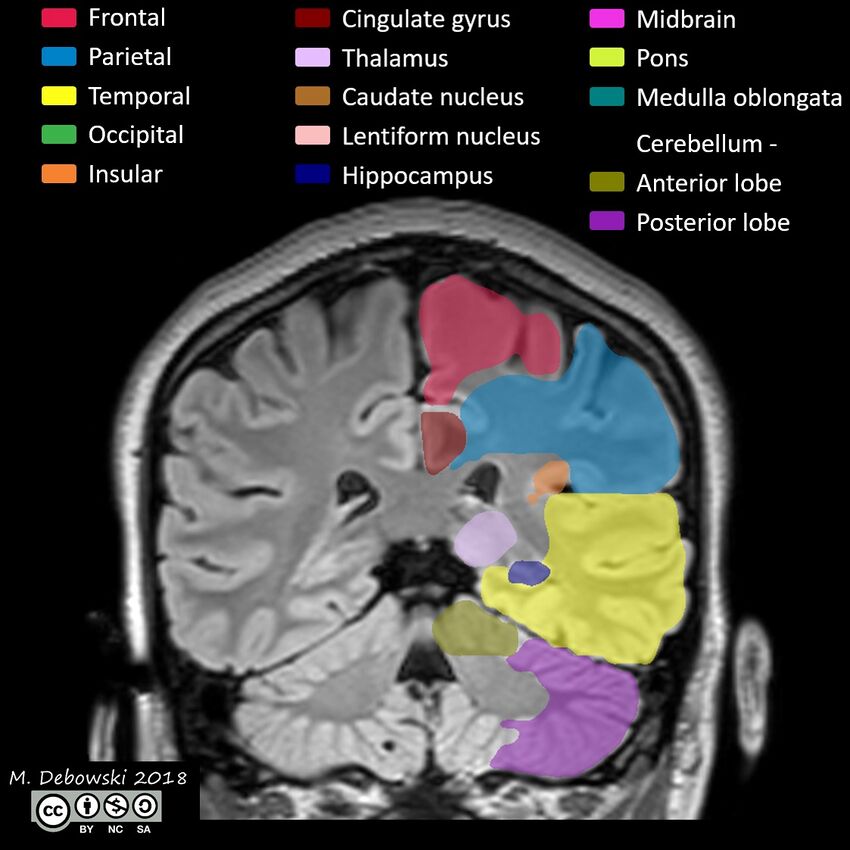 Brain lobes - annotated MRI (Radiopaedia 61691-69700 Coronal 46).JPG
