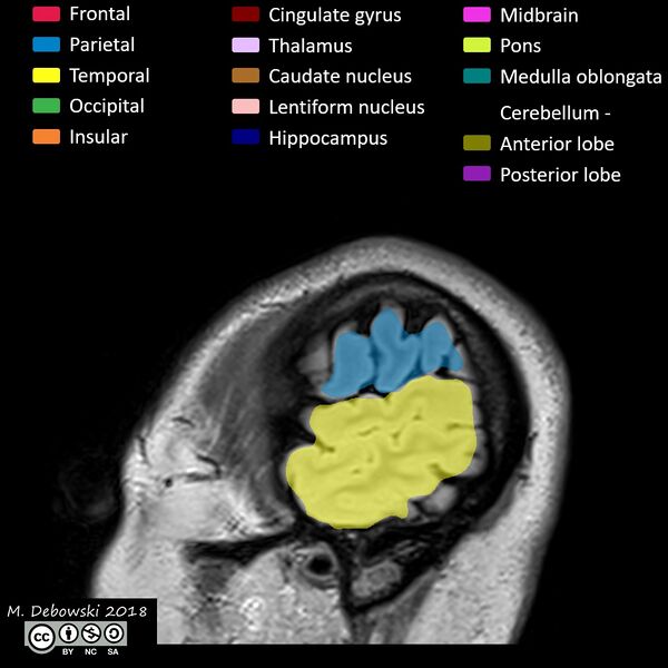 File:Brain lobes - annotated MRI (Radiopaedia 61691-69700 Sagittal 76).JPG