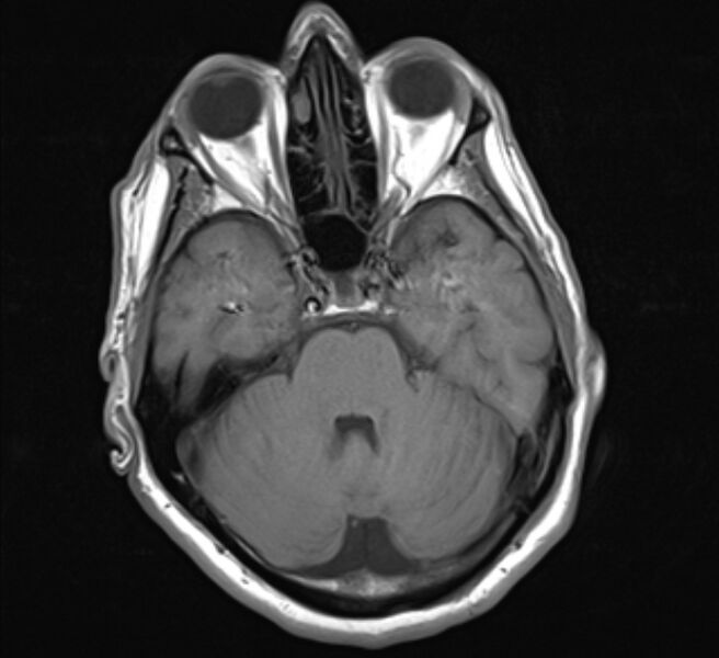 File:Brain metastases - lung cancer primary (Radiopaedia 75060-86115 Axial T1 9).jpg