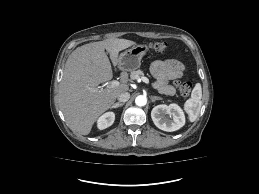 Brain metastases from renal cell carcinoma (Radiopaedia 42222-45328 A 35).jpg