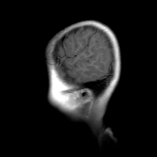 File:Brainstem ganglioglioma (Radiopaedia 10763-11224 Sagittal T1 C+ 2).jpg