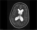 Brainstem glioma (Radiopaedia 21819-21775 Axial T2 23).jpg