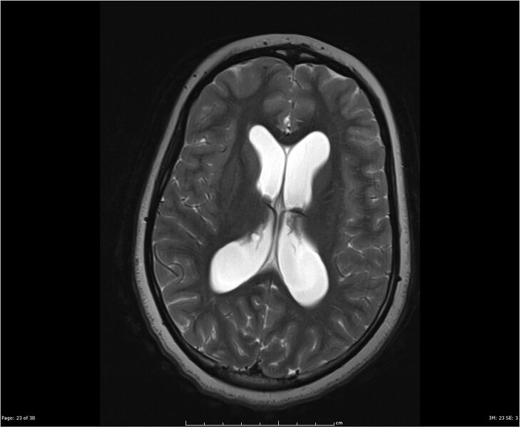 File:Brainstem glioma (Radiopaedia 21819-21775 Axial T2 23).jpg
