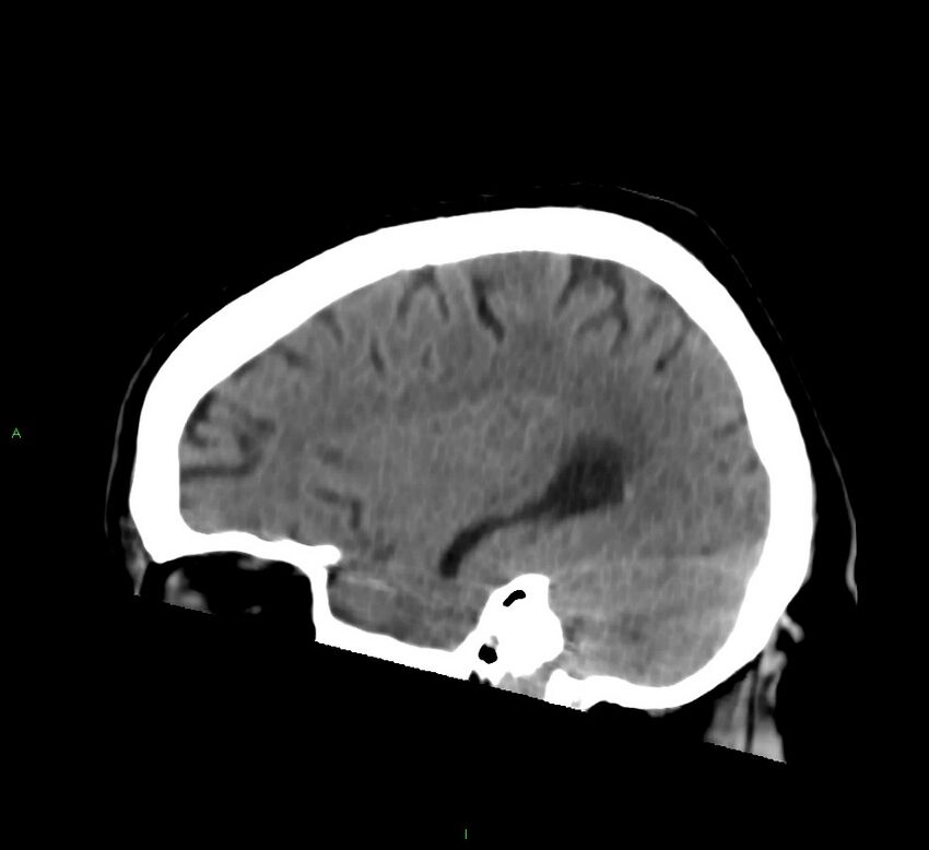 Brainstem hemorrhage (Radiopaedia 58794-66028 C 15).jpg