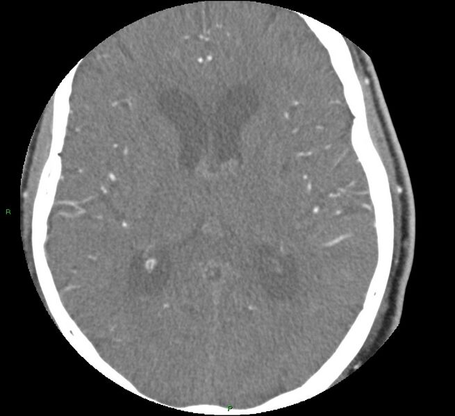 File:Brainstem hemorrhage (Radiopaedia 58794-66028 D 105).jpg