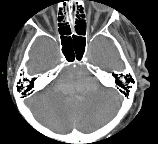File:Brainstem hemorrhage (Radiopaedia 58794-66028 D 54).jpg