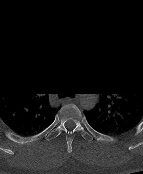 File:Branchial cleft cyst (Radiopaedia 31167-31875 Axial bone window 88).jpg