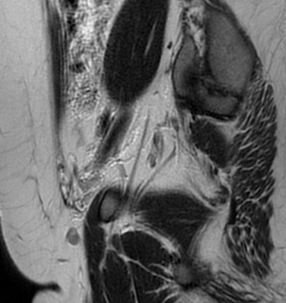 File:Broad ligament leiomyoma (Radiopaedia 81634-95516 Sagittal T2 6).jpg