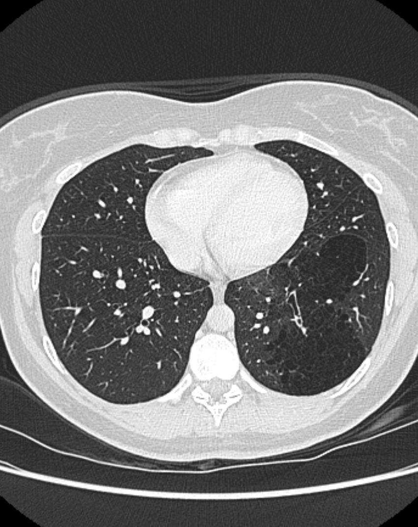 Bronchial atresia (Radiopaedia 50007-55297 Axial lung window 73).jpg