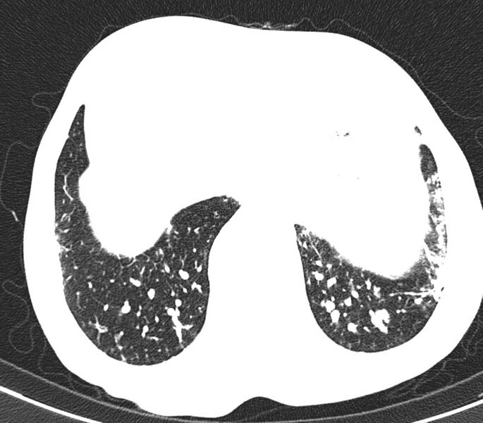 File:Bronchiolitis (Radiopaedia 24616-24887 Axial lung window 54).jpg