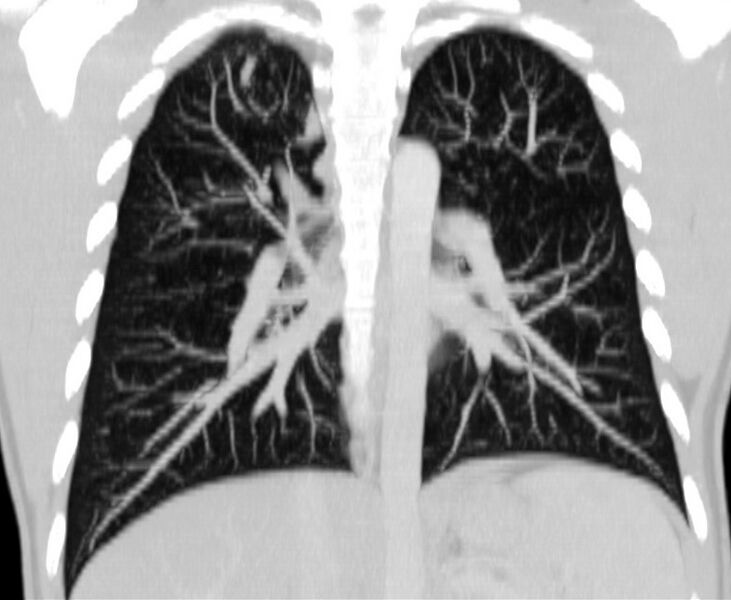 File:Bronchocele (Radiopaedia 12104-12460 Coronal lung window 2).jpg