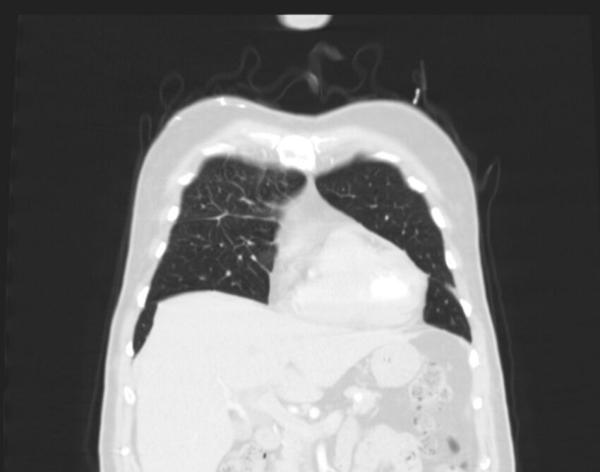 Bronchogenic carcinoma with lymphangitic spread (Radiopaedia 29002-29357 Coronal lung window 12).jpg