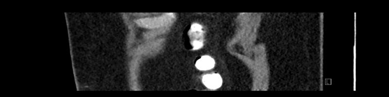 File:Buried bumper syndrome - gastrostomy tube (Radiopaedia 63843-72575 Sagittal Inject 10).jpg
