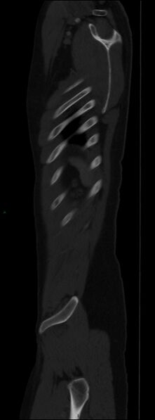 File:Burst fracture (Radiopaedia 83168-97542 Sagittal bone window 109).jpg
