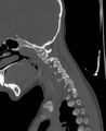Butterfly vertebra (Radiopaedia 77903-90209 Sagittal bone window 12).jpg