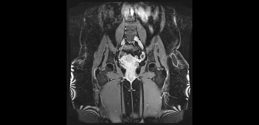 Buttock filler complications (Radiopaedia 63497-72115 Coronal T1 C+ 21).jpg