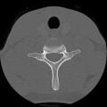 C5 facet fracture (Radiopaedia 58374-65499 Axial bone window 69).jpg