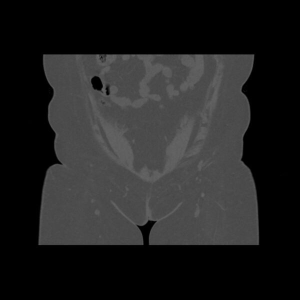 File:Calcific tendinitis of the gluteus medius muscle (Radiopaedia 66998-76318 Coronal bone window 5).jpg