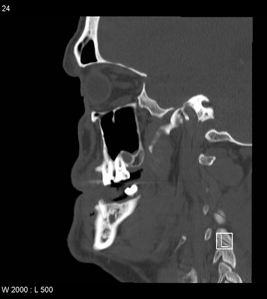 File:Calcification of the transverse band of the cruciform ligament (Radiopaedia 53063-59025 Sagittal bone window 1).jpg