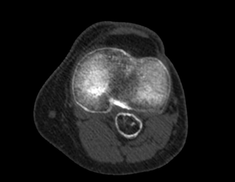 File:Calcified hematoma - popliteal fossa (Radiopaedia 63938-72763 Axial bone window 36).jpg