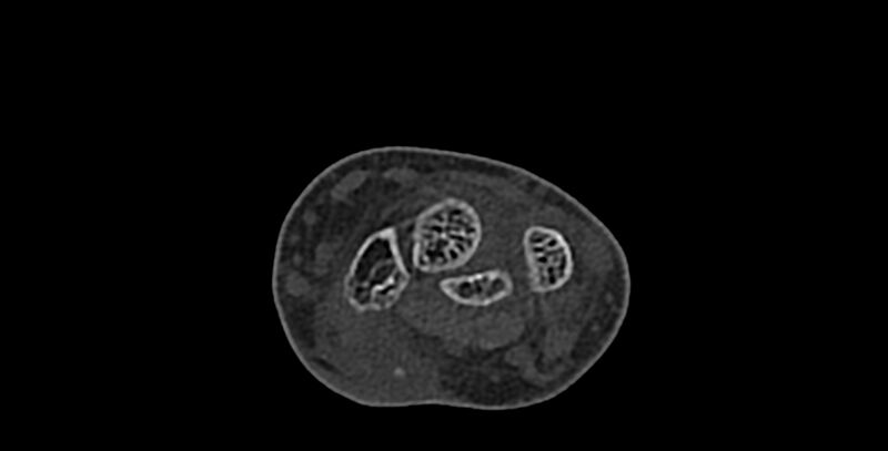 File:Calcifying aponeurotic fibroma (Radiopaedia 88423-105064 Axial bone window 66).jpg
