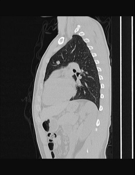 File:Calcifying pulmonary metastases (Radiopaedia 33359-34396 Sagittal lung window 25).jpg
