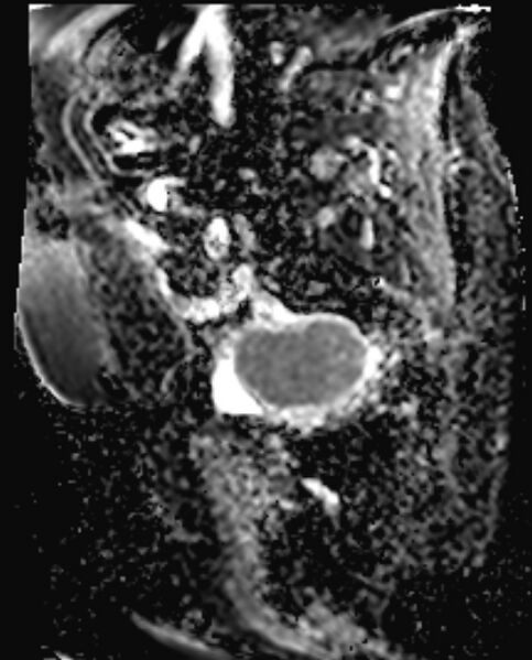 File:Cancer cervix - stage IIb (Radiopaedia 75411-86615 Sagittal ADC 16).jpg